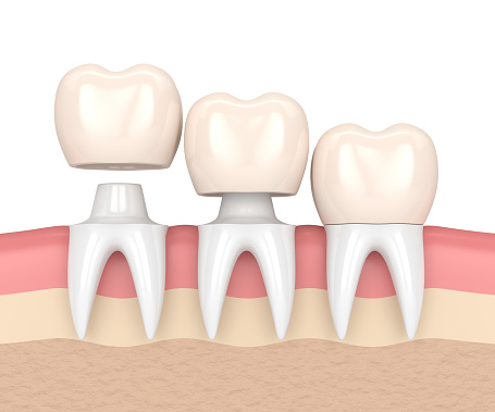 Diagram of dental crowns with varying placement