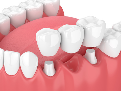 Dental bridge being placed in diagram of lower teeth, at Salem, Or.