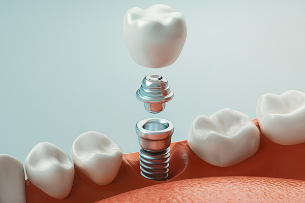 Image of a single tooth implant, at Shull Family Dentistry in Salem, Or.